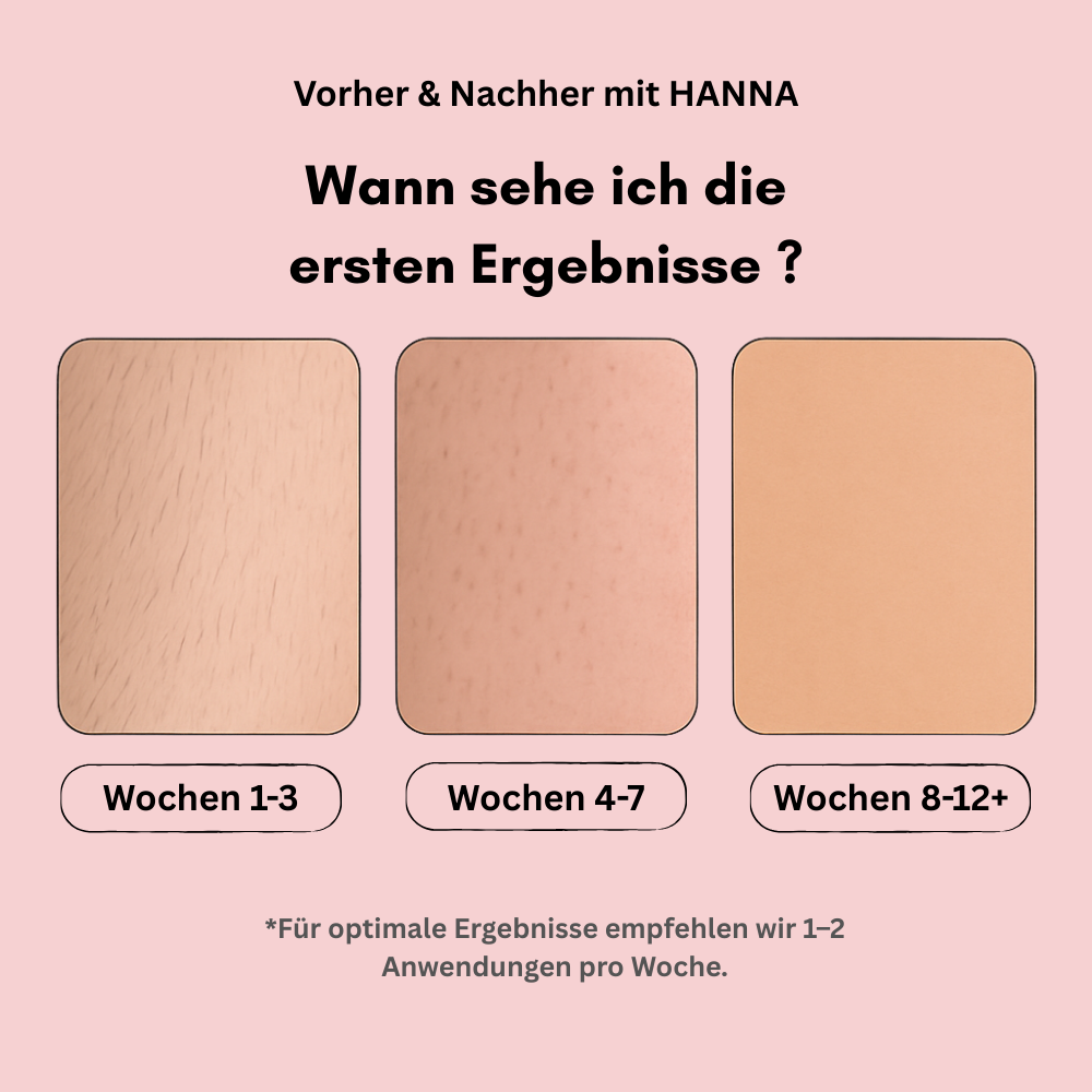 Hanna's IPL Hair Remover | Die Nr. 1 Haarentfernung mit Licht-Technologie für Zuhause