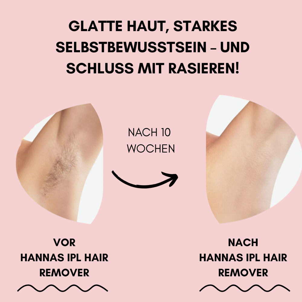 Hanna's IPL Hair Remover | Die Nr. 1 Haarentfernung mit Licht-Technologie für Zuhause