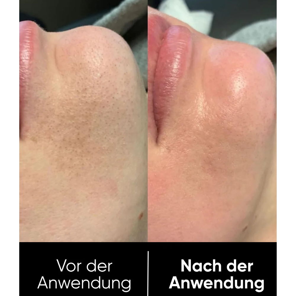 Hanna Reis Peel Shot Duo - Feinere Poren & glattere Haut in nur 3 Minuten