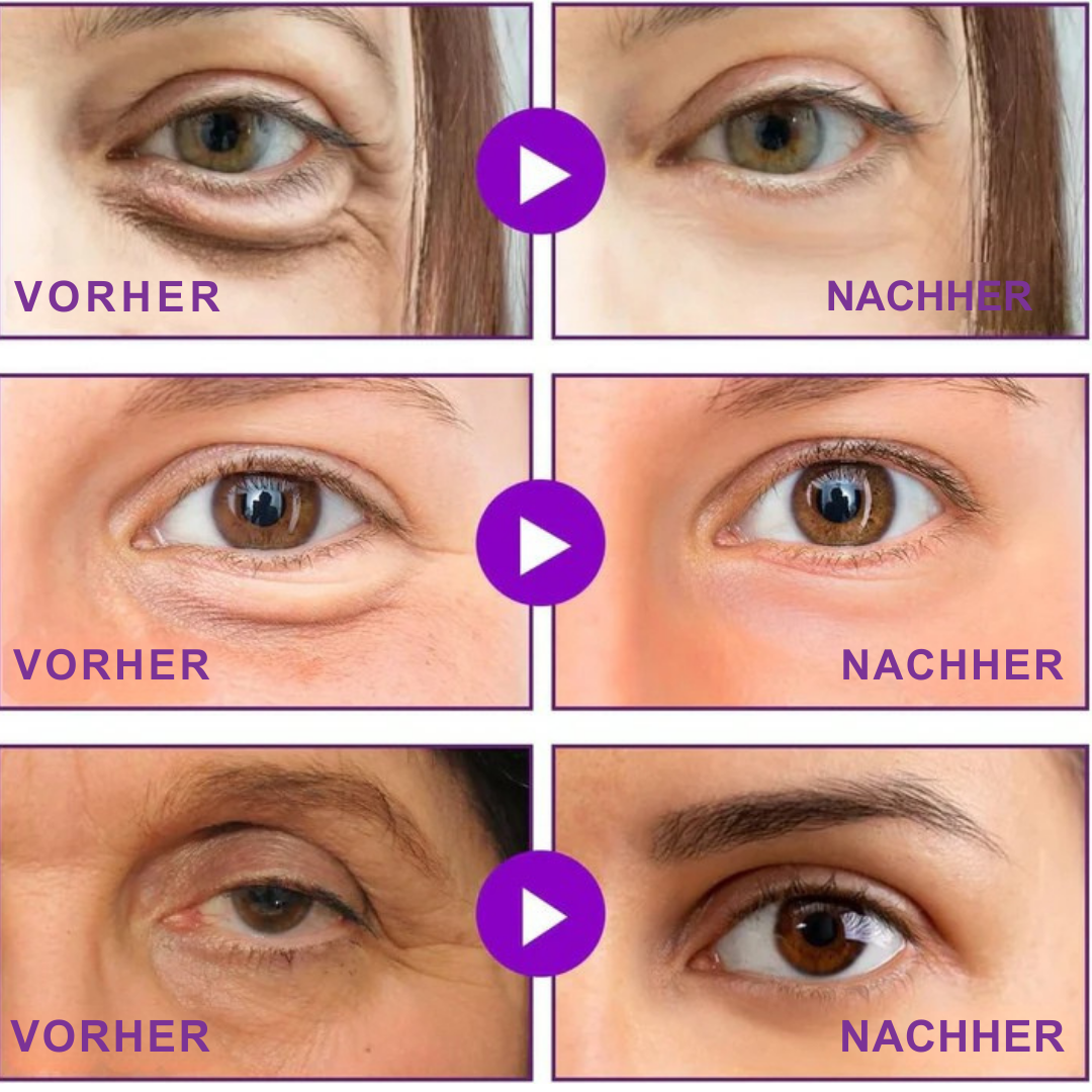 Hanna Lift Mikronadel-Patches - Sichtbar glattere Augen in nur 2 Wochen