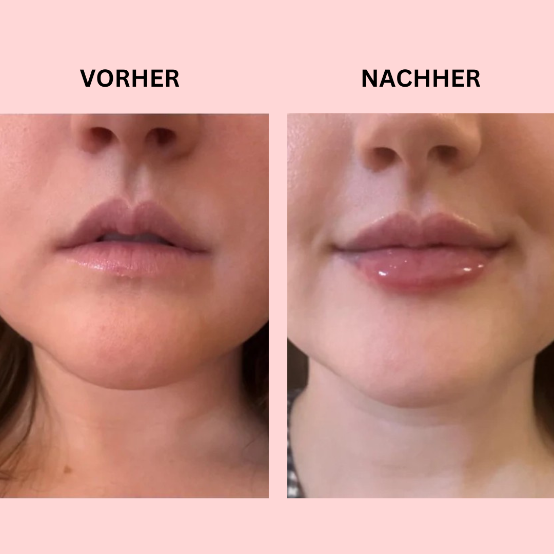 Hanna LipBoost Set - Endlich volle Lippen – ganz natürlich, ohne Spritzen!
