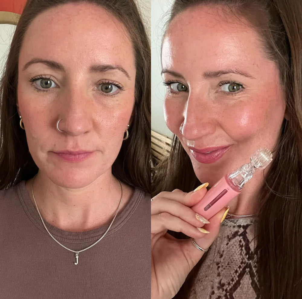 Hanna LipBoost Set - Endlich volle Lippen – ganz natürlich, ohne Spritzen!