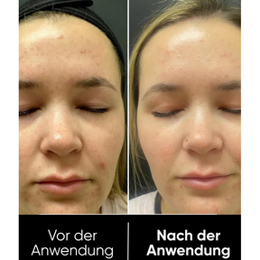 Hanna Reis Peel Shot Duo - Feinere Poren & glattere Haut in nur 3 Minuten