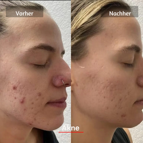 Hanna LED Face Mask PRO – Dein Weg zu glatter, strahlender Haut